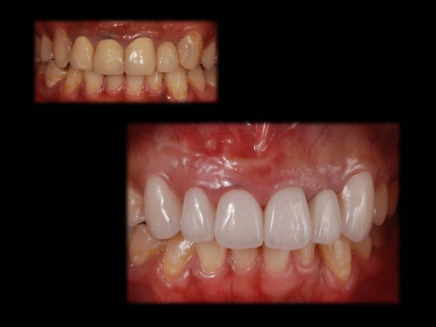 e.max 6前歯 img
